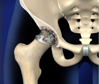Degenerative Joint Disease of the Hip (Osteoarthritis of the Hip)