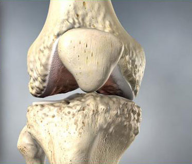 Osteoarthritis-of-the-Knee