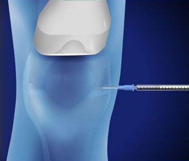 Ultrasound-Guided Injection for Knee Pain